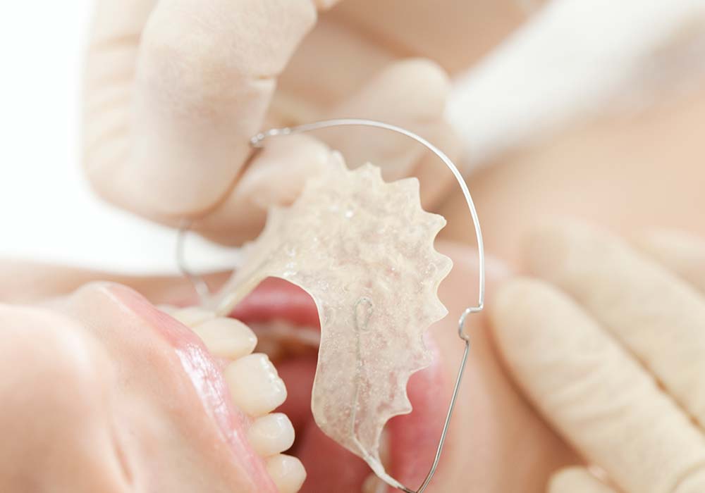 小児矯正治療(自由診療)