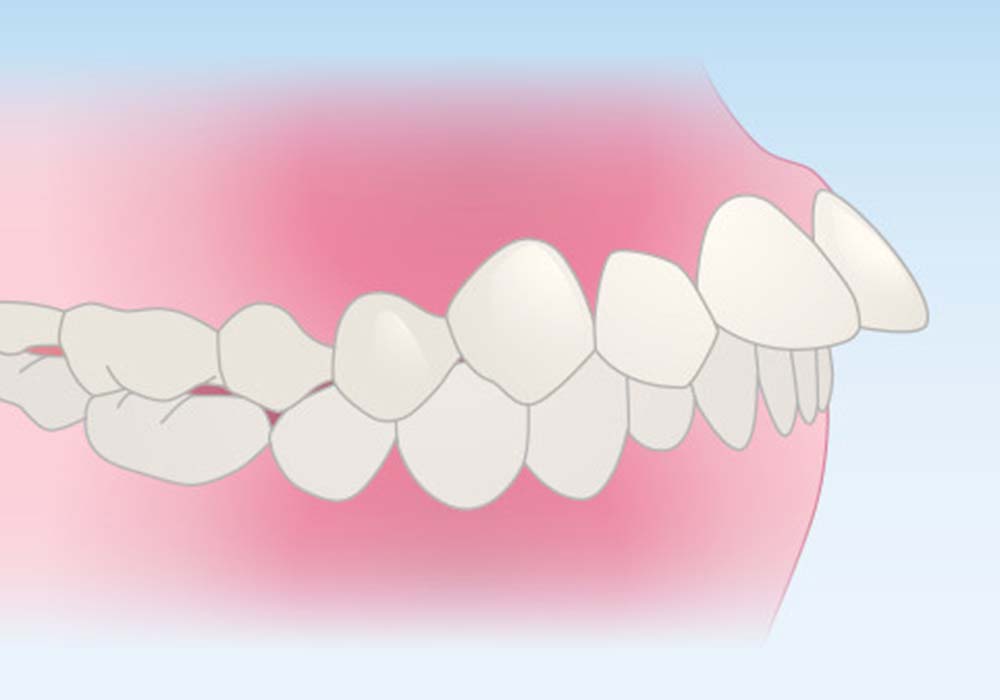 出っ歯(上顎前突)