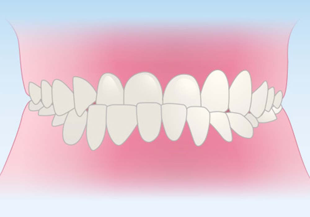 受け口(反対咬合)