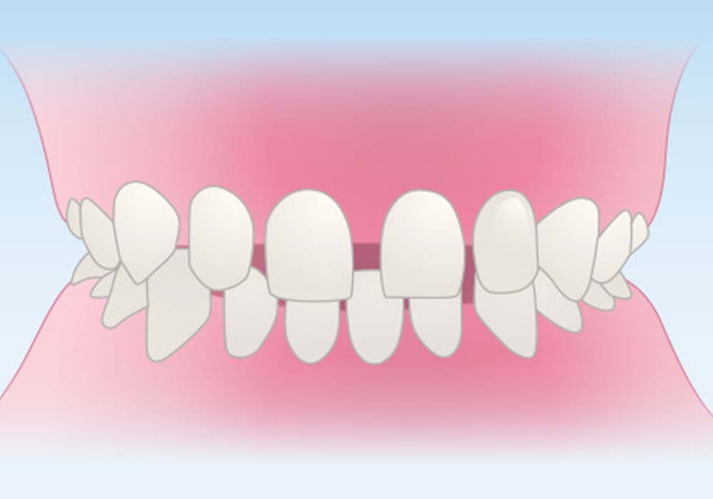 すきっ歯(空隙歯列)