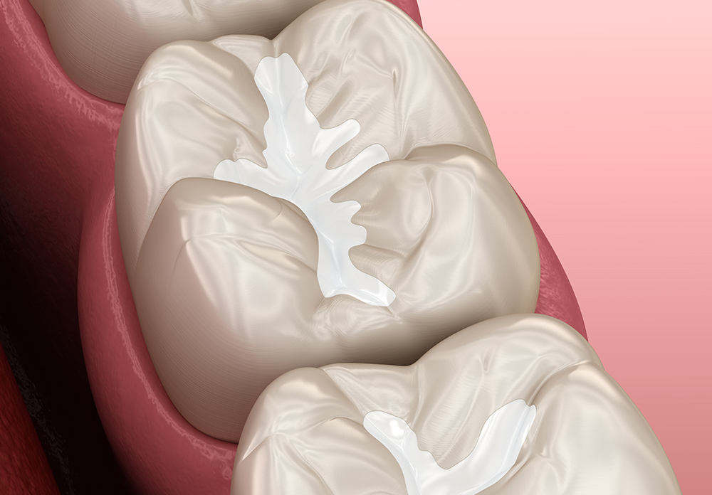 コンポジットレジン