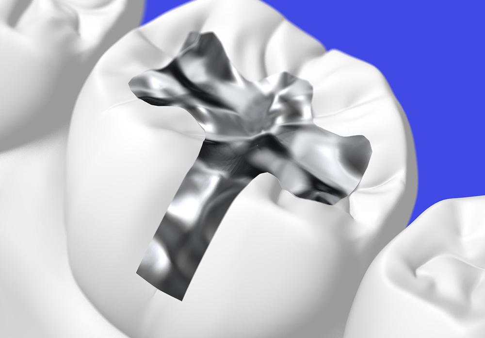 金銀パラジウム合金(銀歯)