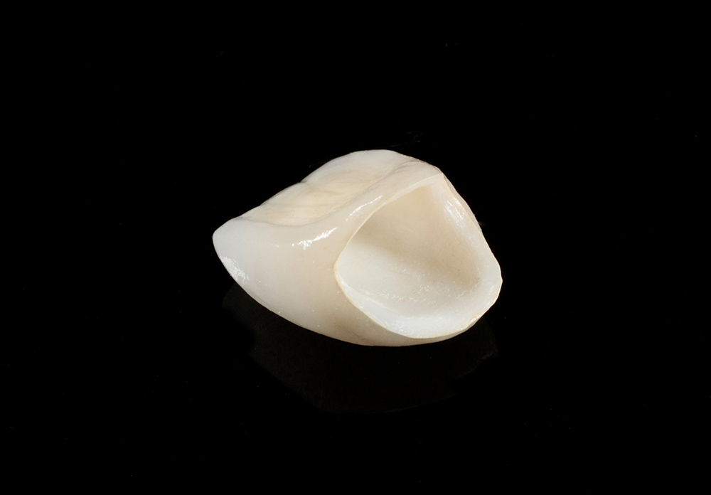 硬質レジン(前歯のみ)