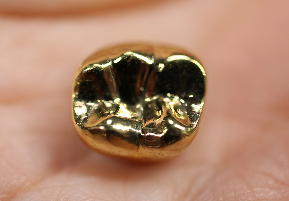 金合金(金歯)(奥歯のみ)