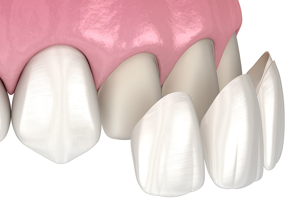 ラミネートベニア(前歯のみ)
