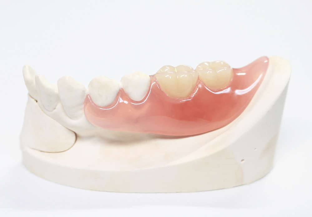 ノンクラスプデンチャー