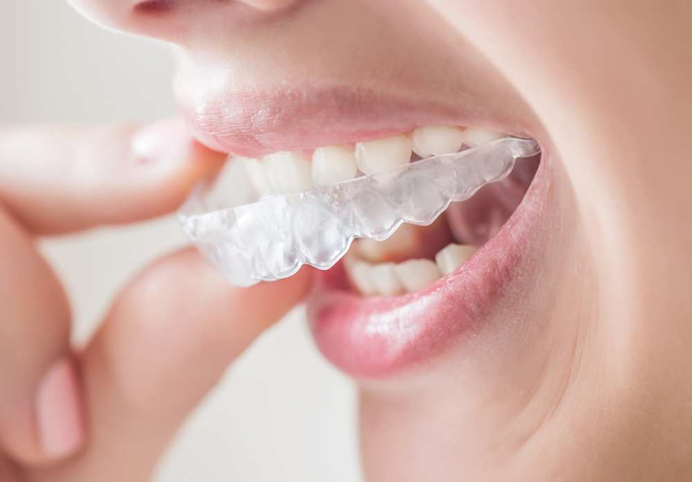 ホームホワイトニング(初期セット)