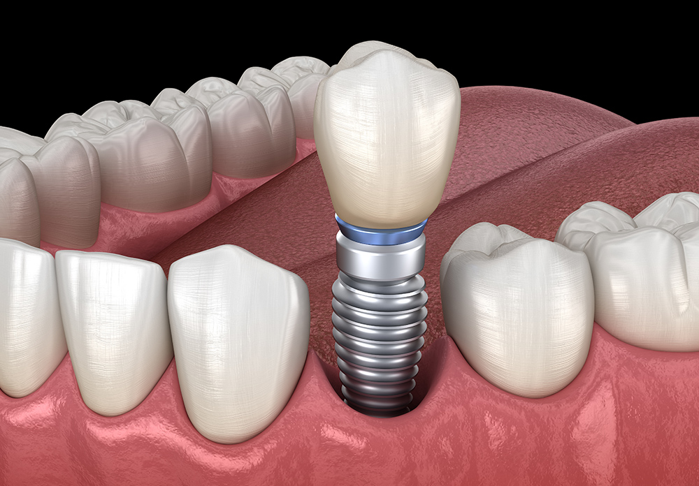インプラント(1本)