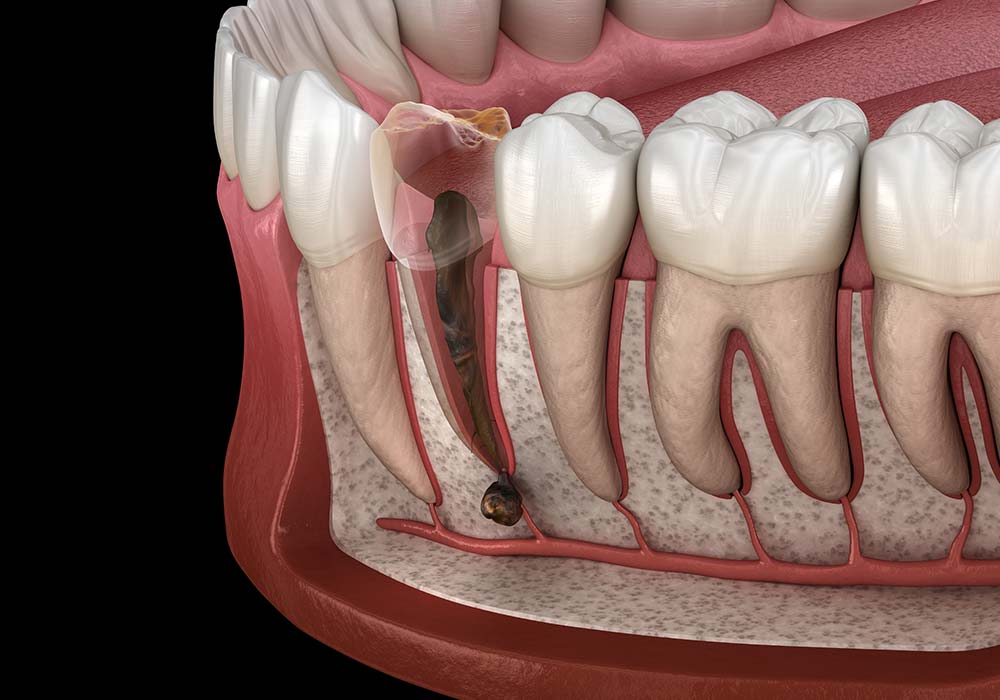 歯周病による全身への影響