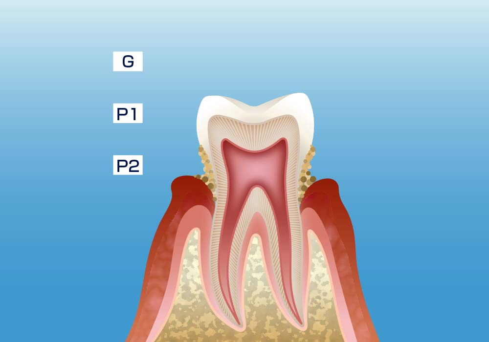 軽度の歯周炎