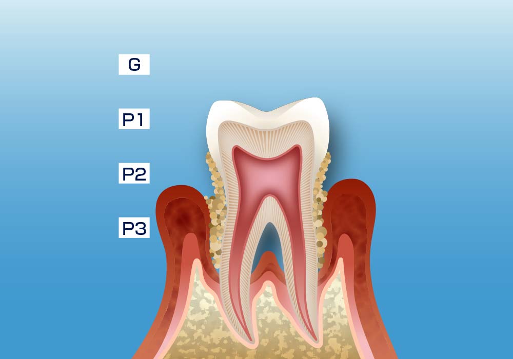 中度の歯周炎
